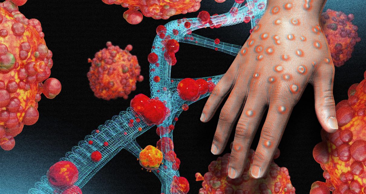 EXPLAINER: WHO changes name of ‘monkeypox’ disease to ‘mpox’ due to stigma